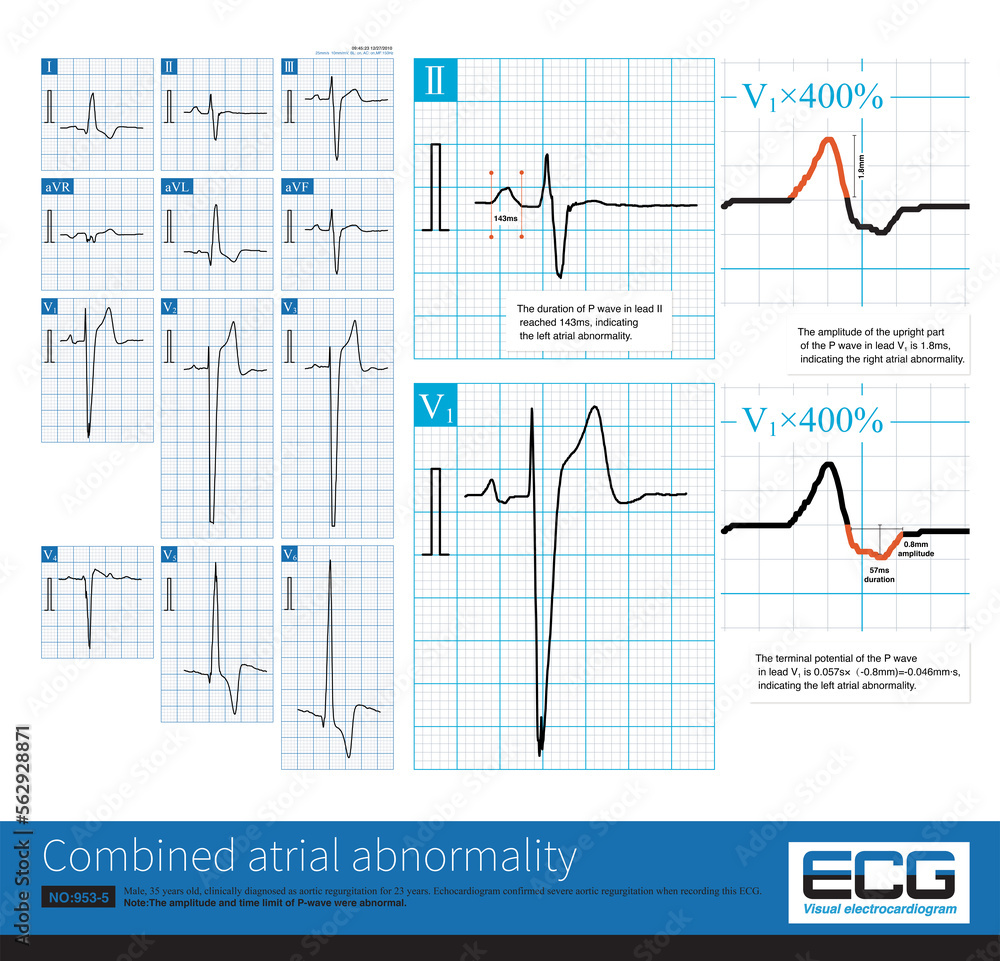 Sometimes, we can use lead V1 to measure the interval and amplitude of ...