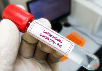 Canvas Print - Synovial fluid anlysis for Undifferentiated arthritis (UA) or Non Specific Inflammatory Arthropathies Test.