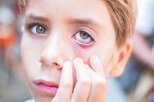 Close Up Of A Child Eye Stye. Ophthalmic Hordeolum Disease.