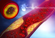 © Rasi - Artery blocked with bad cholesterol. clogged arteries, coronary artery plaque. 3d illustration