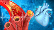 © Rasi - Clogged arteries, coronary artery plaque with human heart. 3d illustration.