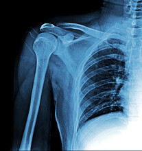 X-ray Film Of Human Shoulder