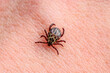 Infectious Encephalitis Tick Insect on Skin. Encephalitis Virus or Lyme Borreliosis Disease Infected Dermacentor Tick Arachnid Parasite Bite Close-up.