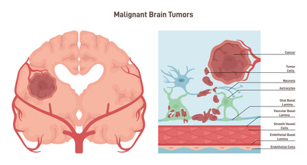 Brain cancer concept. Malignant tumor develops in the human brain.