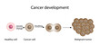 Process of cancer cell development. Cancer disease development. Malignant tumor. Medical biological, science vector illustration.