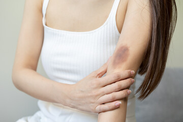 Wall Mural - Close up of stain bruise wound on her arm, contusion asian young woman, girl an accident fell down stairs at home, hand in healing injury by massage hematoma blood. Extravasation blue, purple on skin.