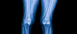 © Issara - Plain radiograph on dark background in hospital.The xray use for diagnosis of the illness of patient.Medical concept.Osteoarthritis of knee in elderly woman.The blue tone of xray shows joint narrowing