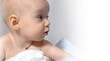 a baby with a hemangioma on his neck lies on a white background