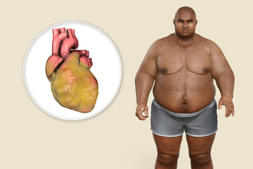 Wall Mural - Obese heart in overweight man, 3D illustration. Concept of obesity and inner organs disease