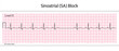 Sinoatrial (SA) Block ECG - 8 Second ECG Paper - Vector Medical Illustration