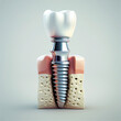 dental implant 3D model. generative ai.