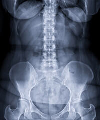 Naklejka na meble X-ray image of lumbar Spine  or L-s spine front view for diagnosis lower back pain.