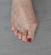 © Wormsmeat - White female foot with bunion or hallux valgus.