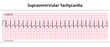 ECG Supraventricular Tachycardia - 8 Second ECG Paper - Electrocardiography Vector Medical Illustration