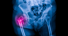 Radiograph On Dark Background In Hospital.The Xray Is Used For Diagnosis Of The Illness Of Patient.Fracture Hip Intertrochanter In Osteoporosis Or Osteopenia Patient At Orthopedic Unit With Red Light.