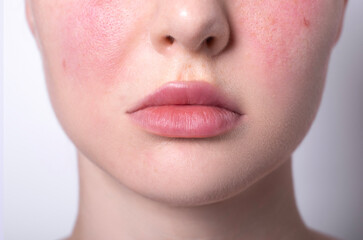 rosacea couperose redness skin, red spots on cheeks, young woman with sensitive skin, patient face close-up 