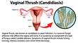 © blueringmedia - Vaginal Thrush (Candidiasis) infographic with explanation