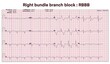 Electrocardiogram show Right bundle branch block. RBBB.Heart beat. CPR. ECG. EKG. Vital sign. Life support. Medical healthcare symbol.