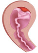 Vector illustration of placental abruption and expulsion.