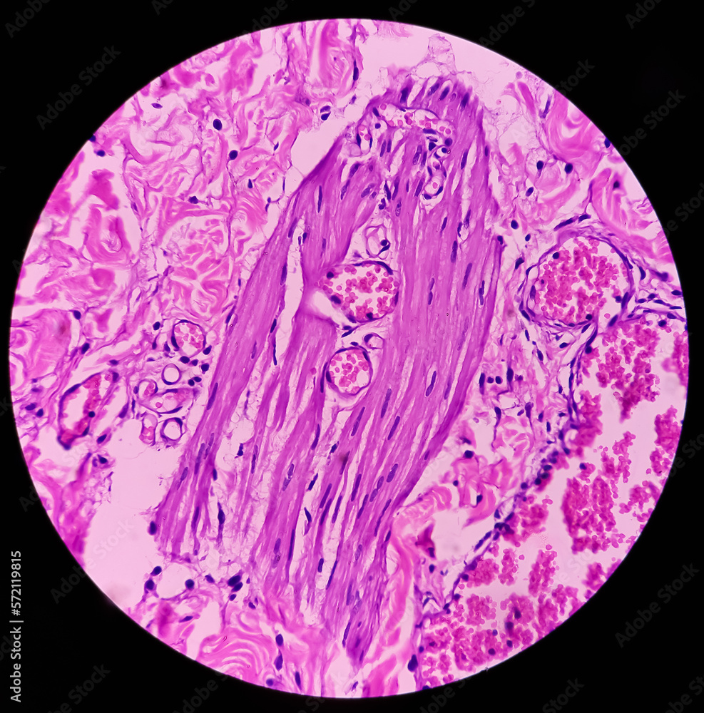 Perianal abscess tissue: Foreign body granuloma, microscopically show ...