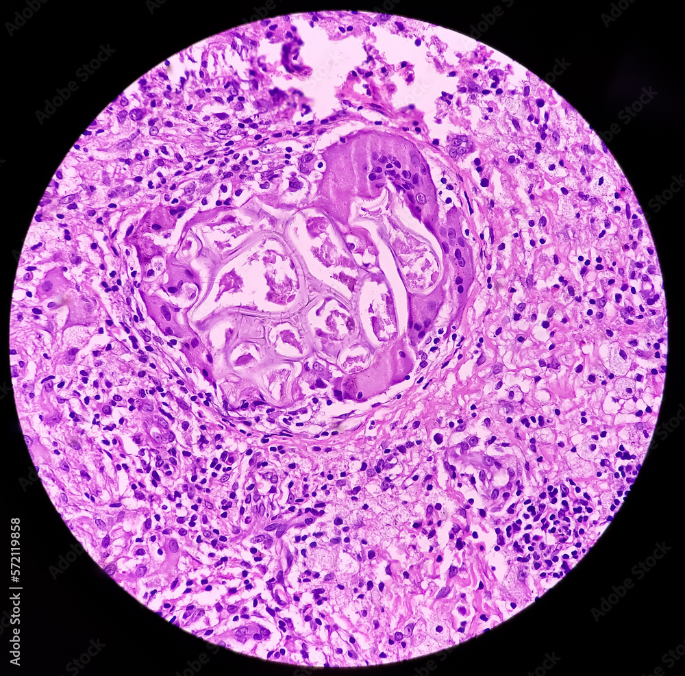 Tissue Abscess Perianal abscess tissue: Foreign body granuloma, microscopically show ...