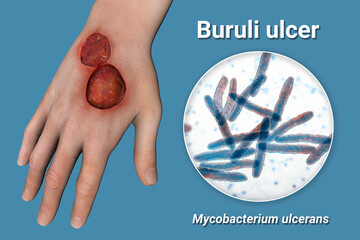 Wall Mural - Buruli ulcer on an arm, 3D illustration. The disease caused by Mycobacterium ulcerans bacteria