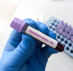 Wall Mural - Blood sample for Plasmablasts marker test, as biomarkers of diagnosis and disease activity in IgG4-related disease (IgG4-RD)