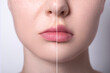 © iso100production - female thin lips before and after hyaluronic acid filler injection as result collage, lip augmentation, lip contour plastic surgery, puffy, plump lips
