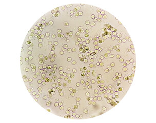 Pyuria or leukocyturia is the condition of urine containing white blood cells or pus. It can be a sign of a bacterial urinary tract infection