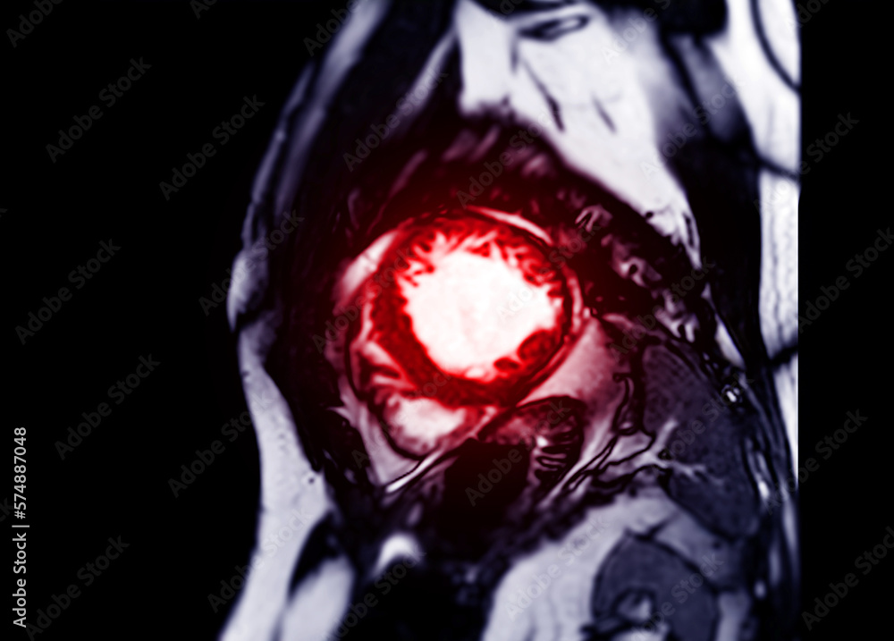 MRI heart or Cardiac MRI in short axis view showing cross-sections of ...