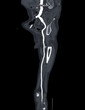 CTA femoral artery run  off MPR curve  showing Left  femoral artery for diagnostic  Acute or Chronic Peripheral Arterial Disease.