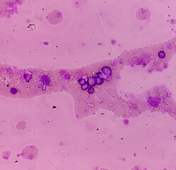 Canvas Print - Chronic myeloid leukemia (CML) in accelerated phase also known as Chronic myelogenous leukemia. Thrombocytosis. Red blood cell. Blood smear.