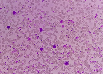 Canvas Print - Chronic myeloid leukemia (CML) in accelerated phase with thrombocytosis. Chronic myelogenous leukemia.