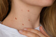 Unrecognizable woman showing her Birthmarks on neck skin Close up detail of the bare skin Sun Exposure effect on skin, Health Effects of UV Radiation Woman with birthmarks Pigmentation and lot of