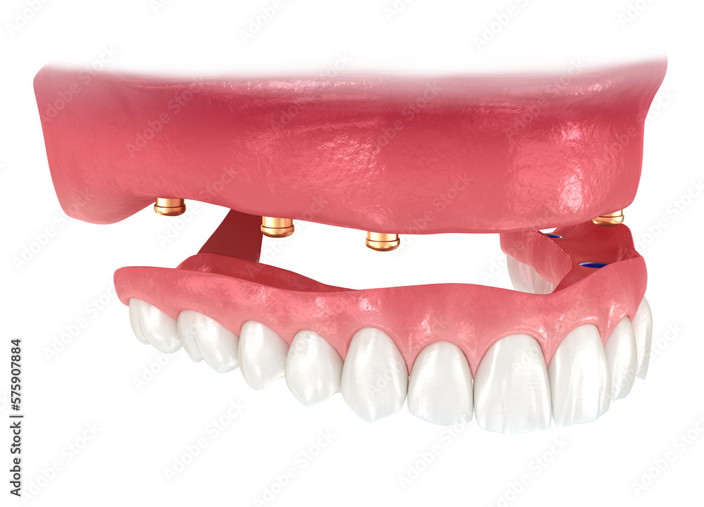 Maxillary Prosthesis Maxillary prosthesis with gum All on 6 system supported by implants ...
