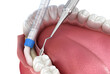 Bone grafting augmentation for tooth implantation. Medically accurate 3D illustration.