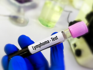 Poster - Blood sample for Lymphoma test. Hodgkin lymphoma, Non-Hodgkin lymphoma. Lymphoma is a cancer of lymphatic system.