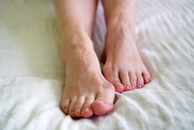 Female Legs With Problem With Women's Feet, Bunion Toes In Bare Feet. Hallus Valgus