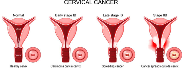 Poster - Cervical Cancer. Stages of a Carcinoma of Cervix.