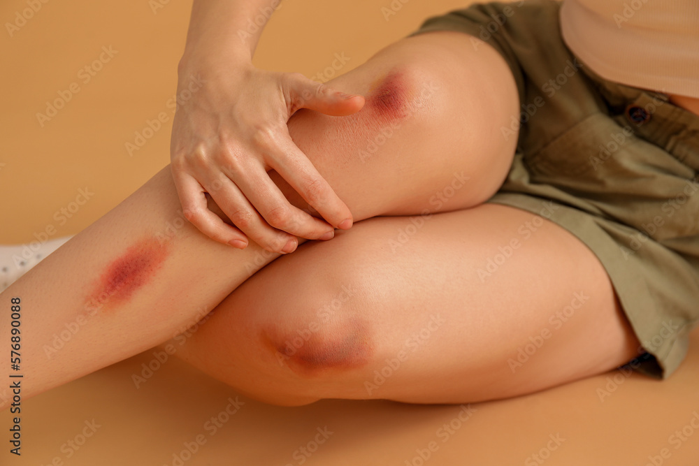 Young woman with bruised legs on beige background, closeup