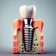 dental implant in 3d model, generative ai.