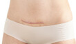 Closeup of woman belly with a scar from a cesarean section with her hands on white background