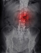© samunella - X-ray image of lambosacral spine or L-S spine showing lesion at L3.