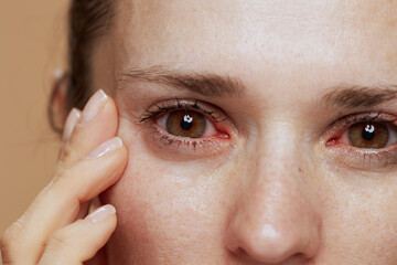 Closeup on young woman with inflamed eyes