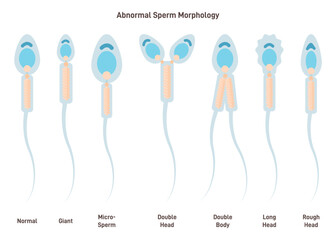 Sperm cell morphology. Normal, abnormal and defective human