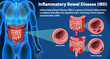 Inflammatory Bowel Disease (IBD) Infographic