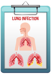 Wall Mural - Lung infection pneumonia vector