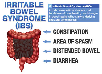 Sticker - Irritable Bowel Syndrome (IBS) Infographic