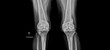© Issara - Radiograph on black background in hospital.Doctor used xray for diagnosis of the illness of patient.X-ray of osteoarthritis or oa of knee.Xray shows osteophyte and loose body with knee joint narrow.