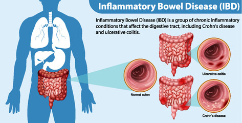 Sticker - Inflammatory Bowel Disease (IBD) Infographic